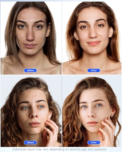 LED Face Mask Light Therapy